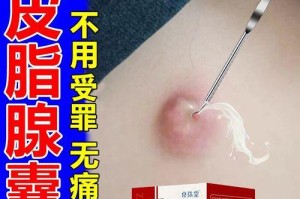 去除粉刺，拥有美丽肌肤的秘密（揭秘祛粉刺的10种方法，告别烦恼）
