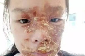 拒绝求爱遭泼硫酸，男子面部严重灼伤（坚守尊严的代价与反思）
